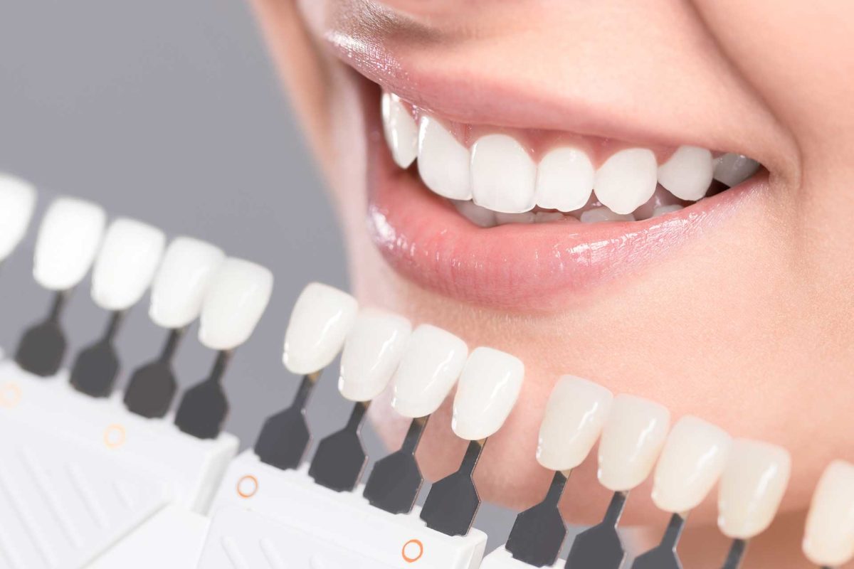 dental implants vancouver